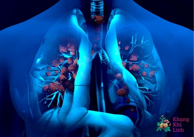 Viêm phế quản bội nhiễm là gì? Bệnh có nguy hiểm không?